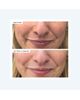111Skin 111Skin Precision Peel - 7