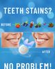 MySmile MySmile Teeth Whitening Kit with 5 LED Light, 18% CP Gel - 3