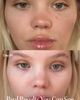 SolaWave SolaWave 3 Minute Light Therapy Acne Spot Treatment - 4